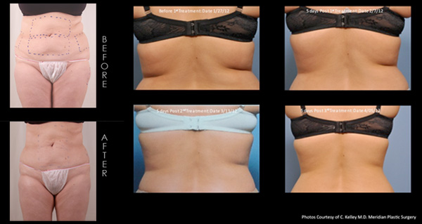 exilis_before&after[1]
